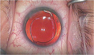 Figure 4. Dilated view of an implanted trifocal IOL (PanOptix, Alcon).