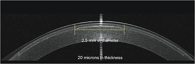 Figure 1. Optical coherence tomography image of an Allotex TransForm lenticule 10 minutes postimplantation. Image courtesy of Allotex.