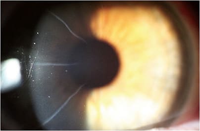 Figure 5. Slit lamp view of RK incisions OD.