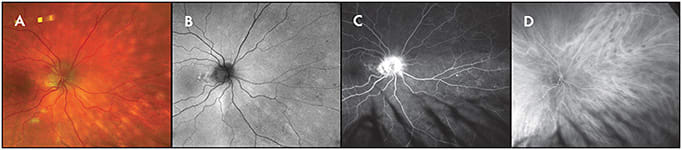 Figure 6. Widefield indocyanine green angiography. Subtle deep yellow infiltrative lesions of presumed choroidal lymphoma are observed in the nasal quadrants on fundus photography (A) with minimal hyperautoflurorescence (B). Given the choroidal location of the lesions, the fluorescein angiogram was unremarkable (C). Widefield ICG, however, revealed multiple focal areas of nonperfusion indicative of choroidal infiltration (D).