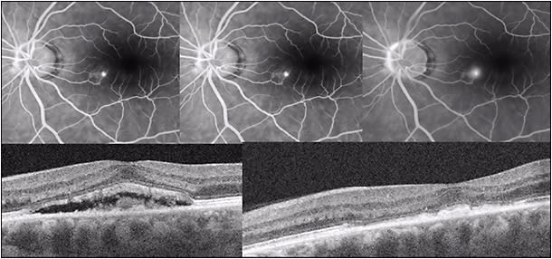 Figure 6. Focal thermal laser therapy of CSC. Fluorescein angiography (early, mid, and late frames, top, showing a single extrafoveal pinpoint RPE leak in the nasal macular region of the left eye) and pre- (bottom left) and post-focal laser (bottom right) OCT images showing resolution of foveal detachment in a patient with CSC treated with photocoagulation of the pinpoint leak.