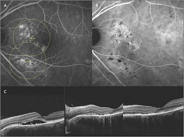 Figure 4. Fluorescein angiography shows late nonspecific choroidal neovascularization and the targets used for photodynamic therapy with verteporfin (Visudyne; Bausch + Lomb) (A). Indocyanine green imaging shows hyperfluorescence corresponding to choroidal leakage (B). Three panels show neovascular and exudative resolution following treatment (C).