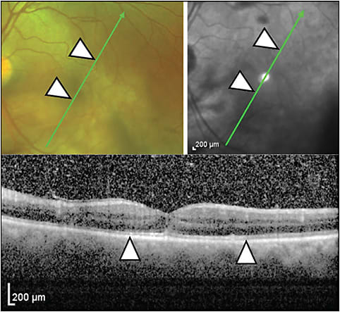 Figure 4. Commotio retinae. There is mild ellipsoid zone hyperreflectivity without thickening in the area of whitening (arrows). In the bottom image (Heidelberg Spectralis), there is decreased reflectivity of the external limiting membrane and ellipsoid zone left of the leftward arrow. Vitreous hemorrhage is also noted.