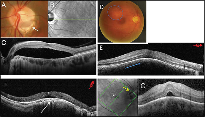 Figure 3. Examples of common differential diagnoses for CSCR. Optic disc pit (arrow) with subretinal fluid (A, B, C), choroidal hemangioma visible on the fundus as an orange choroidal lesion (blue circle) and hyporeflective mass leading to RPE displacement on OCT, and SEF (D, E), Dome shaped macula with a thin choroid and subretinal fluid above a dome deformation (F, white arrow), tilted disc syndrome (G, arrow) and subretinal fluid.