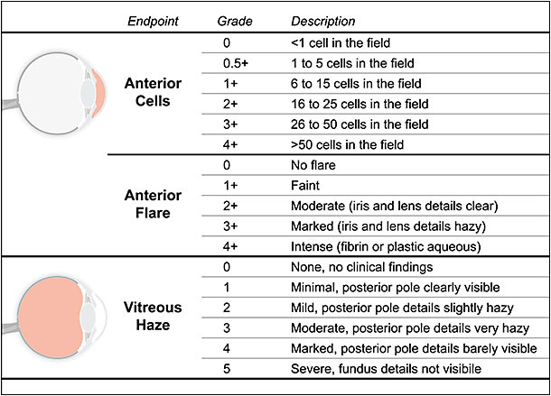 Figure 2. Clinical endpoints to evaluate the severity of intraocular inflammation. The severity of an intraocular inflammatory response is evaluated by measuring the level of cells and protein in the anterior and/or posterior chamber. Anterior cells are a clinical endpoint that measures the level of red and white blood cells in the anterior chamber, and it is graded on a standardized scale developed by the Standardization of Uveitis Nomenclature (SUN) Working Group.7 When counting anterior cells, the field size is a 1x1 mm slit beam. Anterior flare measures the level of protein that accumulates in the anterior chamber, and it is also graded on a standardized SUN scale.7 Vitreous haze measures the degree to which leaked cells and protein obscure a physician’s view of the posterior pole through the vitreous, and it is often graded on a photographic scale that was originally described by Nussenblatt et al.7,9,10