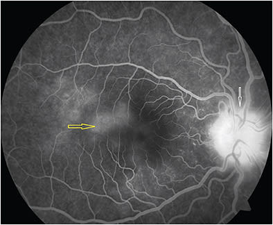 Figure 3. Late-phase fluorescein angiography showing staining of spots temporal to macula (yellow arrow) and disc leakage (white arrow). Reprinted with permission from Reprinted with permission from Chandrasekaran PR, Kerala J Ophthalmol. 2021;33(2):214-216. DOI:10.4103/kjo.kjo_14_21