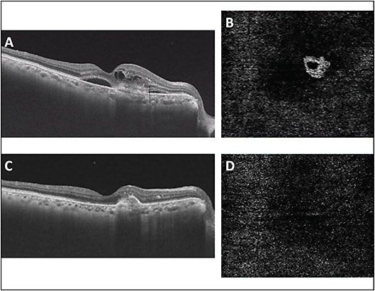 Figure 2. Optical coherence tomography (OCT) showing presence of intraretinal cystoid spaces, subretinal fluid and hyper-reflectivity in subretinal space with a breach in retinal pigment epithelium (RPE) (A). OCT angiography (OCTA) imaging (Triton; Topcon) shows the neovascular complex in outer retinal slab just above RPE (B). The diagnosis of retinal angiomatous proliferation was made. Post one intravitreal ziv-aflibercept injection, OCT shows absence of intra- and subretinal fluid with fibrovascular pigment epithelial detachment (C). OCTA shows nearly a complete disappearance of neovascular complex (D).