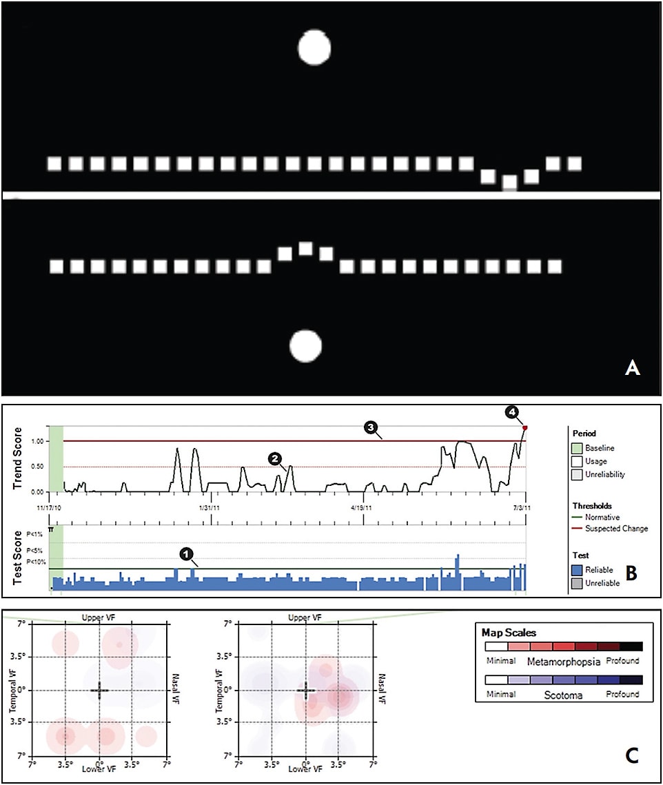 Figure 5. Sample Foreseehome test as visualized by patient (A) and report with alert points (B) and heat maps demonstrating areas of metamorphopsia in the patient&amp;#x2019;s central visual field (C).