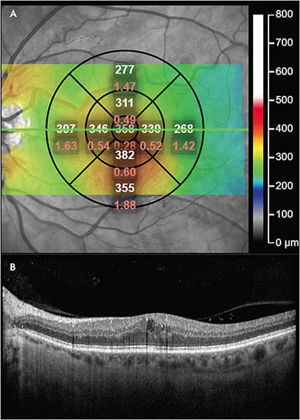 Figure 1. Example of a patient with mild diabetic macular edema and vision of 20/25. Protocol V was designed to provide guidance about treatment options for patients like this with edema and good vision. Image courtesy of Retinal Consultants of Texas.