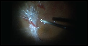 Figure 1. Intraoperative assessment of diabetic tractional retinal detachment with fibrovascular proliferation. The posterior hyaloid is attached and subhyaloid hemorrhage is present proximal to the optic nerve head.