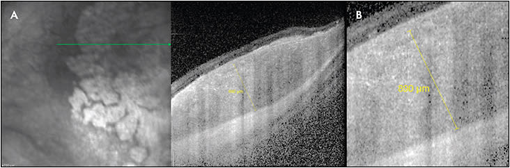 Figure 9. Enhanced-depth imaging OCT of an amelanotic choroidal melanoma years following brachytherapy. The OCT image (A) is able to show the entire thickness of the lesion, which can be measured with the native OCT software (enlarged image B) and tracked over time.