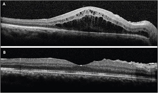 Figure 4. A 43-year-old male developed CME in the right eye 3 weeks after vitrectomy and scleral-sutured intraocular lens for aphakia (A). The CME resolved 2 months after treatment with topical steroids and NSAIDs and intravitreal injection of sustained release 0.7 mg dexamethasone (B). 
IMAGE COURTESY OF JAYANTH SRIDHAR, MD.