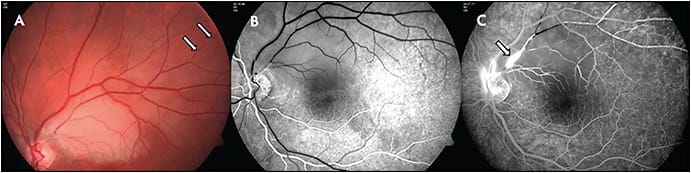 Figure 1. Left eye of a 34-year-old female showing superonasal macular branch retinal artery occlusion with retinal whitening and Gass plaques in distal arteries (arrows) (A). Early-phase fluorescein angiography displaying reduced background fluorescence in the area of the acute branch retinal artery occlusion, and delayed filling of the superotemporal arteries (B). Mid phase showing arterial wall hyperfluorescence (arrow), and partial arterial filling (C).