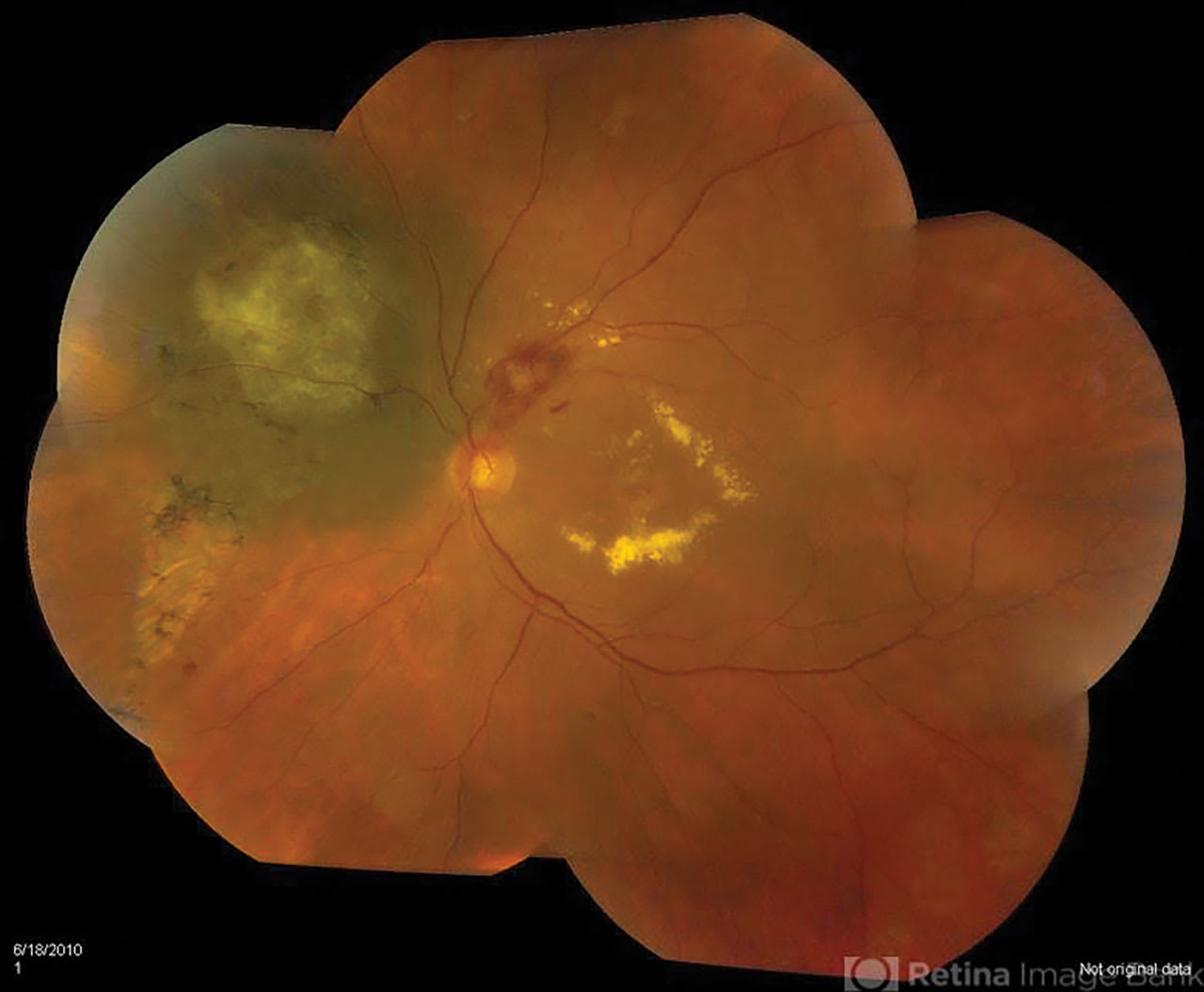 <p><strong>Figure 1. </strong>Radiation retinopathy with macular exudates following radioactive plaque therapy for choroidal melanoma. <em>This image was </em><em>originally published in the Retina Image Bank. Jason S. Calhoun. Melanoma With Radiation Retinopathy. Retina Image Bank. 2013; 7797.<span class="Apple-converted-space">&nbsp; </span>Courtesy and copyright of the American Society of Retina Specialists.</em></p>