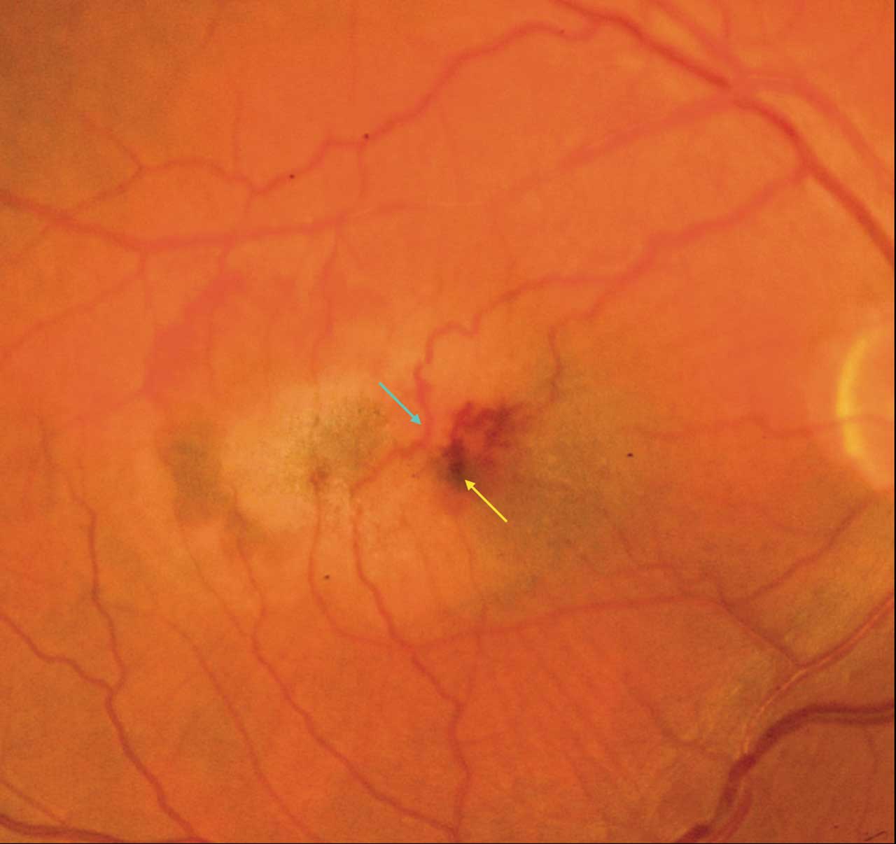 Figure 2.  A color fundus photograph demonstrating neovascular type 2  macular telangiectasia. The blue arrow indicates retinal-retinal anastomoses.  The yellow arrow identifies a dilated aneurysm with hemorrhagic features.