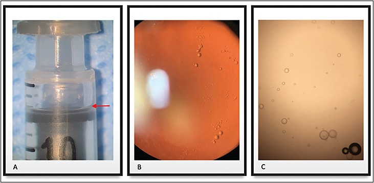 Figure 1. Silicone oil from the syringe. Silicone oil layer (red arrow) in the barrel of the syringe adjacent to the rubber stopper (A). Silicone oil droplets in the anterior vitreous of a patient who had recently recovered from non-infectious endophthalmitis following intravitreal injection of an anti-angiogenic drug (B). Multiple silicone oil droplets seen at light microscopy released from the syringe after agitation (C).
