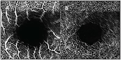 Figure 1. Blink artifact shown on the OCTA superficial vascular complex (A) and deep vascular complex (B). Note the sudden transition from the sharp vasculature toward the top of the images, then the gradual reconstitution of the sharpness toward the bottom.