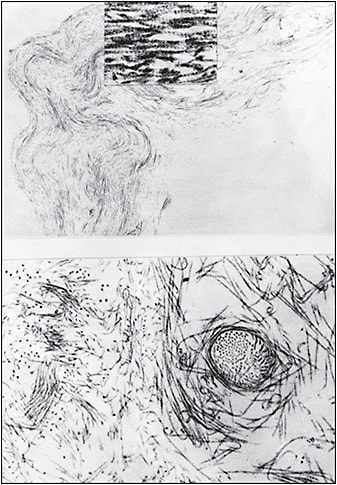 Figure 2. Ultrastructure of human vitreous fibers. Transmission electron microscopy of human vitreous detected bundles of collagen fibrils shown longitudinally in the upper image and in cross-section in the lower image. The inset in the upper image is a high magnification view of the bundle of fibrils, demonstrating their collagenous (striated) nature. Reprinted with permission from Sebag J, Balazs EA. Morphology and ultrastructure of human vitreous fibers.&amp;#xA0;Invest Ophthalmol Vis Sci. 1989;30(8):1867-1871.