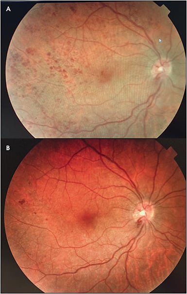 Figure 1. Fundus photography of the right eye of a patient with 9 months duration of vision loss from a combined central retinal vein and artery occlusion and BCVA of 20/800 (A). No macular edema was noted. Vision improved to 20/40 at 3 months after intravitreal injection of autologous CD34&amp;#x2B; stem cells from bone marrow and remained improved at 20/63 at 6 months follow-up visit (B). Marked resolution of retinal hemorrhages are noted with some improvement in retinal perfusion on fluorescein angiography.