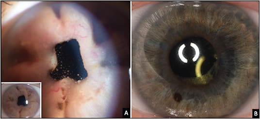 Figure 4. A 64-year-old female patient was referred with initial diagnosis of hypertensive uveitis with heterochromia