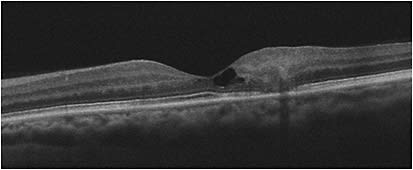 Figure 2. The internal limiting membrane drapes with a normal foveal contour over degenerative cysts resulting from macular telangiectasia.