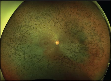 Figure 1. Widefield fundus photograph of a 33-year-old female with 2 pathogenic variants of the MYO7A gene locus, manifesting in Usher syndrome and keratoconus.