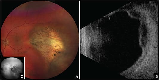 Figure 7. A 54-year-old male patient presented with 1 month of severe pain in the left eye with diffuse conjunctival and scleral congestion