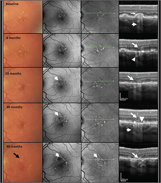 Figure 1. Multimodal imaging of age-related macular degeneration illustrating progression from incomplete to complete retinal pigment epithelium (RPE) and outer retinal atrophy (iRORA and cRORA) over 48 months