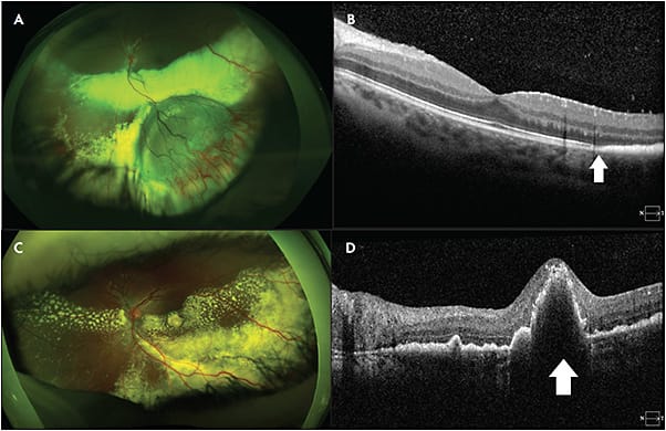 Figure 2. Stage 3A1 Coats disease. A patient presented with an inferotemporal subtotal exudative retinal detachment with dense posterior exudation (white arrow on optical coherence tomography [OCT]) (A, B). After treatment with laser photocoagulation, intravitreal bevacizumab, and posterior sub-Tenon triamcinolone, the exudative detachment improved, but unfortunately the lipid exudation formed a subfoveal nodule (white arrow on OCT) (C, D). Images courtesy of Cynthia Toth, MD