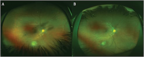 Figure 1. Fundus images of a pediatric patient with congenital toxoplasmosis of the right eye. Reactivation of the inferior congenital toxoplasmosis lesion is associated with vitritis and mild vasculitis, with a characteristic “headlights in the fog” appearance (A). Fundus appearance after consolidation of the reactivation (B).