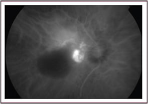 Figure 1. Late indocyanine green angiography of polypoidal choroidal vasculopathy in a peripapillary location&#xA;Image courtesy of Jay S. Duker, MD