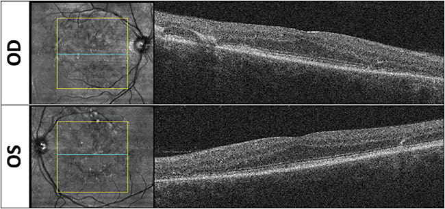 Figure 3. Optical coherence tomography of a patient who presented with a complaint of vision loss.