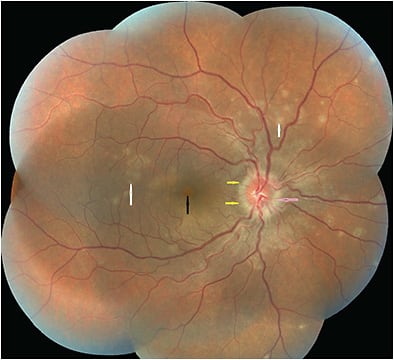 Figure 1. Fundus photo montage showing dots nasal to the macula and close to the optic disc (yellow arrow), spots in the paramacular and posterior pole (white arrow), orange-yellow granularity at the fovea (black arrow), and optic disc edema (pink arrow). Reprinted with permission from Chandrasekaran PR, Kerala J Ophthalmol. 2021;33(2):214-216. DOI:10.4103/kjo.kjo_14_21