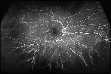 Figure 2. In this fluorescein angiography image, although microaneurysms and mild leakage are located in the posterior pole, the periphery shows a large area of retinal nonperfusion.