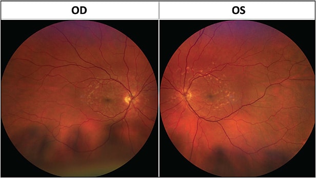 Figure 1. Dilated fundus photo of a patient who presented with a complaint of vision loss.