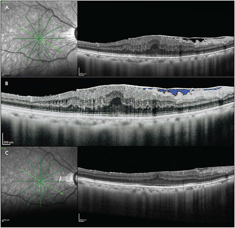 Figure 3. An eye with sukima. Preoperative optical coherence tomography (OCT; Heidelberg Spectralis, A) showed separation of the epiretinal membrane and the inner limiting membrane marked in light blue (B). VA was 20/35. Postoperative OCT (C) showed that retinal thickness had decreased along with decreased disruption of ellipsoid zone and almost normalized inner nuclear layer. Visual acuity was 20/25.