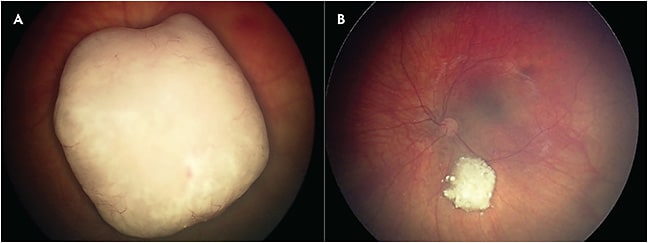 Figure 2. Images obtained before (A) and after (B) ophthalmic artery infusion showing dramatic and immediate (and permanent) resolution of retinal detachment.