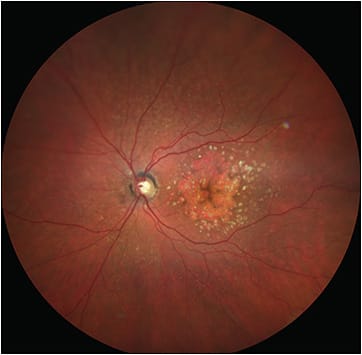 Figure 1. A fundus photograph of geographic atrophy.