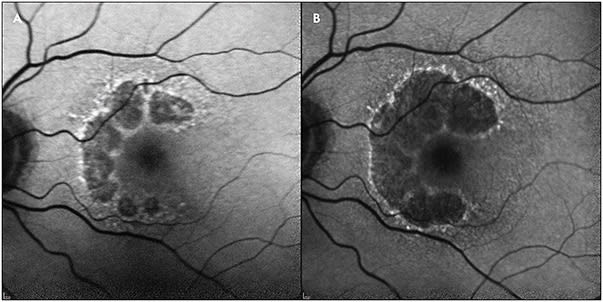 Figure 1. A fundus autofluorescence image showing progression of a dry age-related macular degeneration lesion from 2017 (A) to 2019 (B).