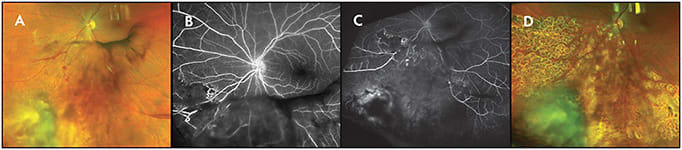 Figure 4. Widefield fluorescein angiography. Retinal neovascularization and vitreous hemorrhage (proliferative radiation retinopathy) following treatment of choroidal melanoma with episcleral brachytherapy (A). Retinal ischemia is evident in the inferonasal periphery (B, C). Regression after treatment with sectoral panretinal photocoagulation (D).