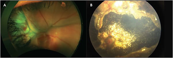 Figure 3. Stage 4 Coats disease. A patient presented with a total exudative retinal detachment and ocular hypertension (A). After undergoing external drainage, cryotherapy, and posterior sub-Tenon triamcinolone, the patient was able to fix and follow and intraocular pressure normalized (B).