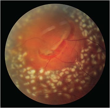 Figure 2. Fresh laser retinopexy of a symptomatic horseshoe retinal tear. A 360-degree laser barricade with more than 3 rows of moderately white burns was performed to induce chorioretinal adhesion around the retinal break.