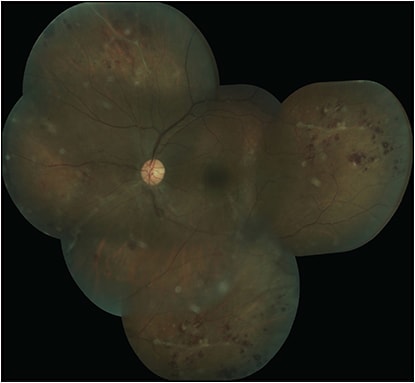Figure 3. Eales Disease with capillary nonperfusion, periphlebitis and peripheral neovascularization. FIGURE REPRINTED WITH PERMISSION FROM ELSEVIER.1
