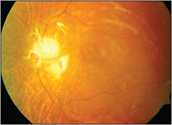 Figure 6. Silicone oil is often necessary for tamponade following surgery for PVR retinal detachment, as shown in this eye, in particular in the setting of inferior pathology.