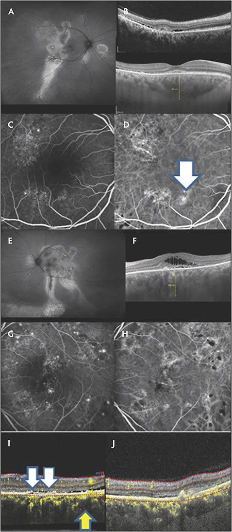 Figure 3. Autofluorescence of the right eye shows diffuse and asymmetric discontinuity (A). Optical coherence tomography of the right eye shows pachychoroid, pachy vessels, and subretinal exudation (B). Fluorescein angiography shows nonspecific leakage with 2 focal areas of subretinal exudation in the right eye (C). Indocyanine green imaging of the right eye shows patches of hyperfluorescence (white arrow; D). Autofluorescence of the left eye shows diffuse and asymmetric discontinuity (E). Optical coherence tomography of the left ye shows pachychoroid and subretinal and intraretinal exudation (F). Fluorescein angiography shows chronic and nonspecific leakage as well as several areas of focal exudation (G). Indocyanine green imaging of the left eye shows a moderate degree of hyperfluorescence (H). Optical coherence tomography angiography shows choroidal pachy vessels (yellow arrow) and the double-layer sign (white arrow; I). Optical coherence tomography angiography shows a probable polyp with neovascularization (J).