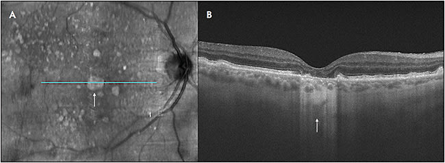 Figure 2. Fundus autofluorescence and optical coherence tomography scan of a patient with geographic atrophy