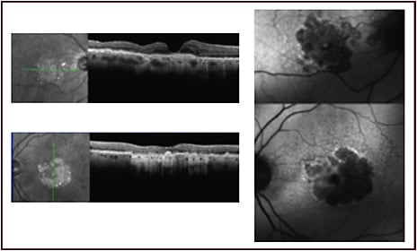 Figure 3. Optical coherence tomography and fundus autofluorescence images from eyes with both geographic atrophy and neovascular age-related macular degeneration on anti&#8211;vascular endothelial growth factor therapy. The optical coherence tomography images show choroidal neovascularization responding well to anti&#8211;vascular endothelial growth factor treatment, with no signs of exudation, and the corresponding fundus autofluorescence images show extensive central geographic atrophy, accounting for some of the decreased visual acuity in both eyes.&#xA;Images courtesy of Carl D. Regillo, MD, FACS