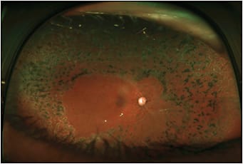 Figure 4. Postoperative wide-field fundus photograph demonstrating successful repair of diabetic tractional retinal detachment and improvement in retinal architecture.