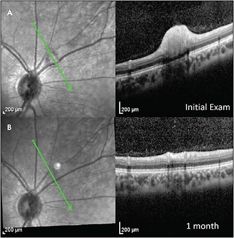 Figure 3. Acute and chronic cotton wool spot. Optical coherence tomography (Heidelberg Spectralis) demonstrates thickening of the retinal nerve fiber layer in the acute setting (A). One month later, there is decreasing thickness of the inner retinal layers (B). In some chronic lesions, outer nuclear layer thickening can be seen (not shown).