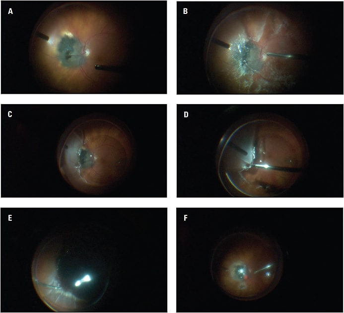 Figure 1. (A) Previously treated tumor and nasal retinal detachment prior to repair of the latter; (B) Triamcinolone (Triesence, Alcon) staining to highlight the vitreous over the tumor and the retinal detachment for inducing posterior vitreous detachment; (C) Perfluorocarbon liquid to stabilize the posterior retina and macula; (D) Forceps for peeling of hyaloid and PVR membranes; (E) Bimanual instrumentation (lighted pick and forceps) for anterior vitreous dissection; (F) Laser applied to retinal breaks and surrounding tumor under air.